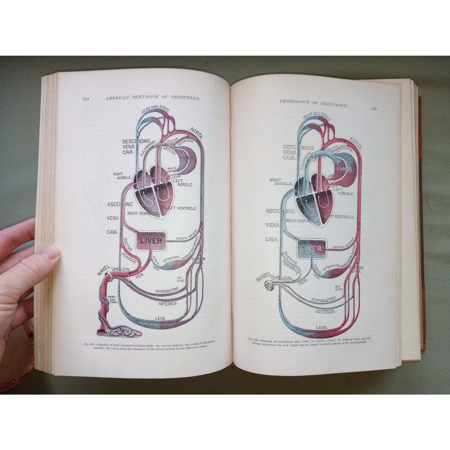 American Text-book of Obstetrics For Practitioners & Students 1895 Illustrated